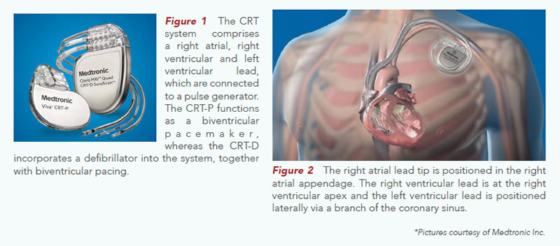 The position of the CRT system in the heart. National Heart Centre Singapore