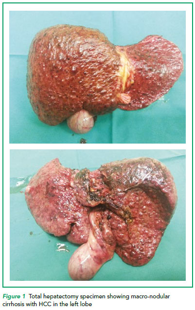 Total hepatectomy specimen showing macro-nodular cirrhosis with HCC in the left lobe - SGH
