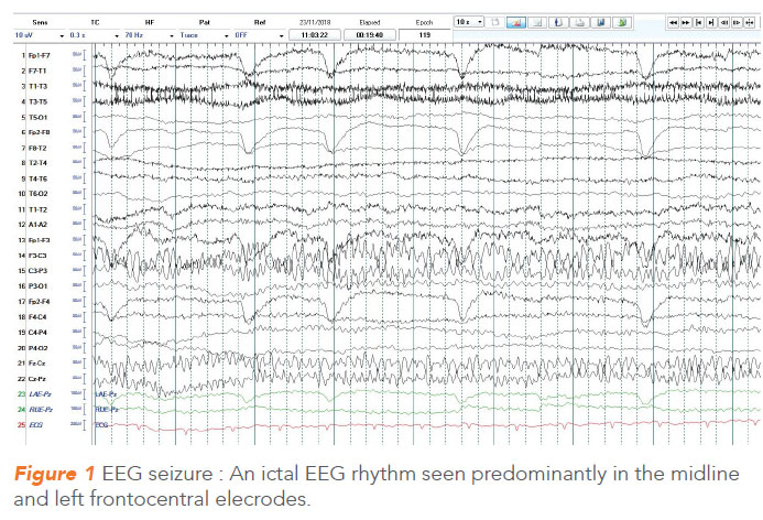 EEG seizure. NNI 