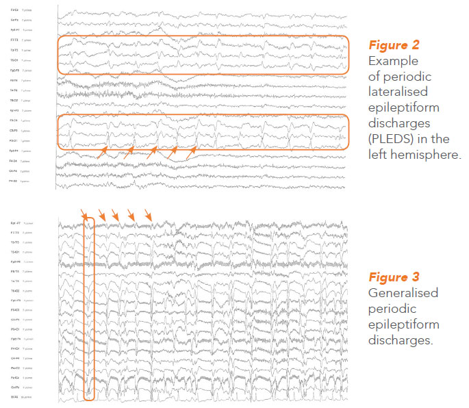 Periodic lateralised and generalized periodic epileptiform discharges. NNI