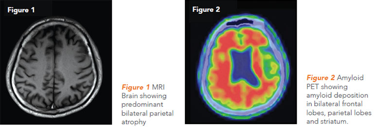 Brain images showing the onset of Alzheimers. National Neroscience Institute.