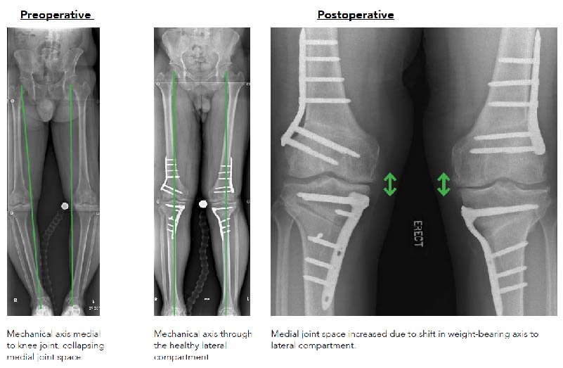 Knee Preservation Osteotomy Sgh