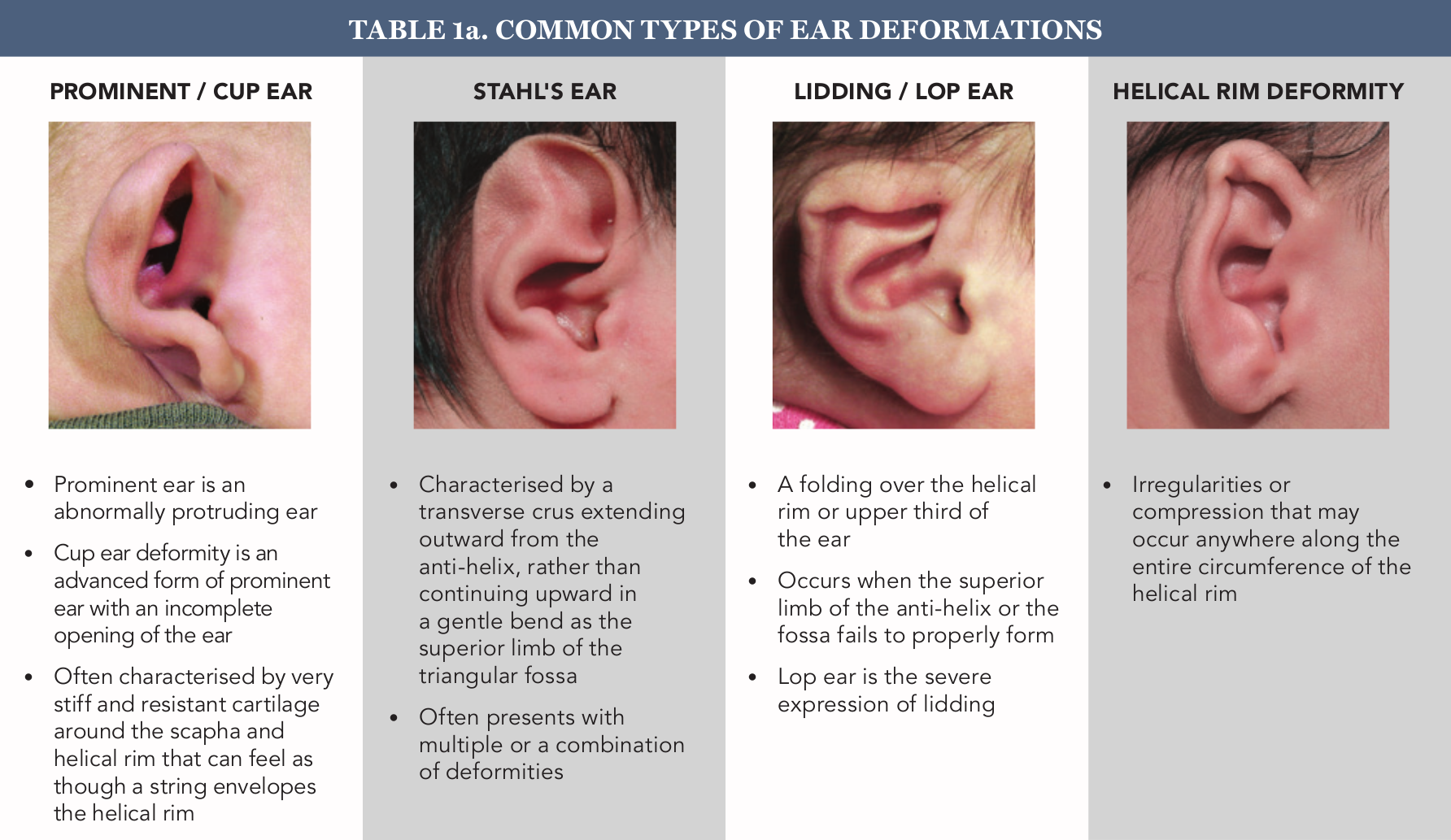 Congenital Ear Anomalies