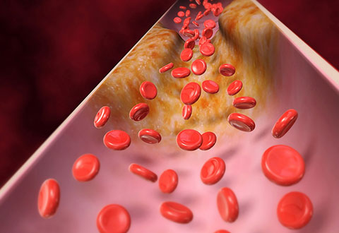 How to lower LDL
