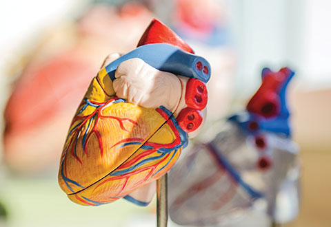 Heart model - Dilated Cardiomyopathy