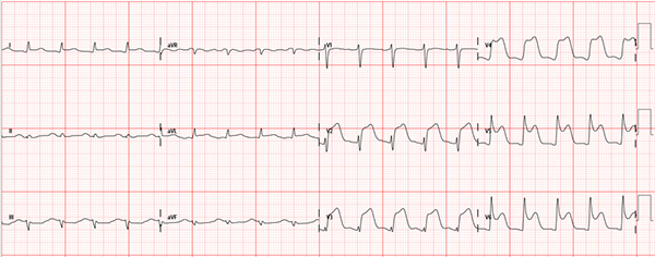 ECG Anterolateral STEMI