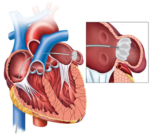 Percutaneous Left Atrial Appendage Closure