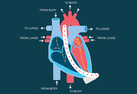 LVAD on heart