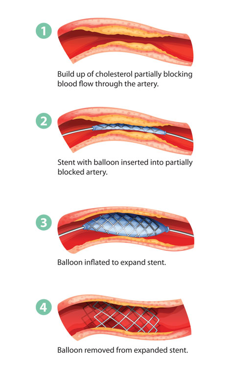 stenting to allow blood flow in heart's artery