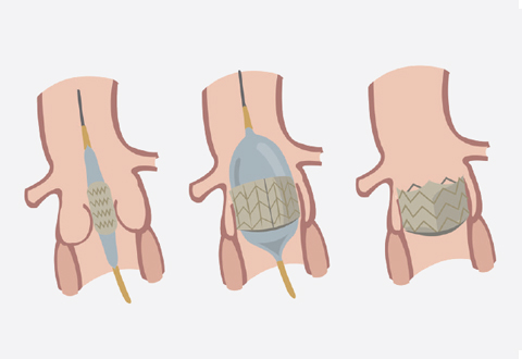 percutaneous pulmonary valve implantation (PPVI)