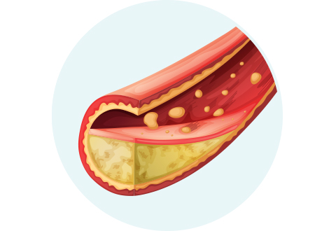 Atherosclerosis 