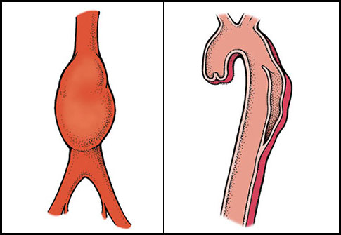 aortic aneurysm vs aortic dissection