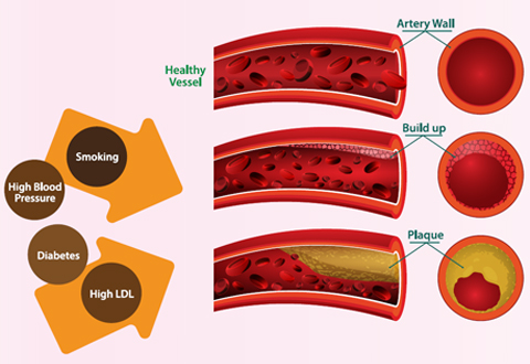 Atheroslcerosis Progression