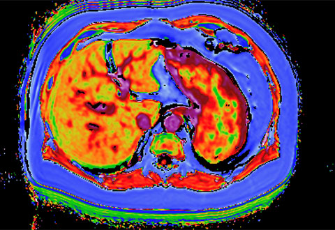 MRI scan for fatty liver