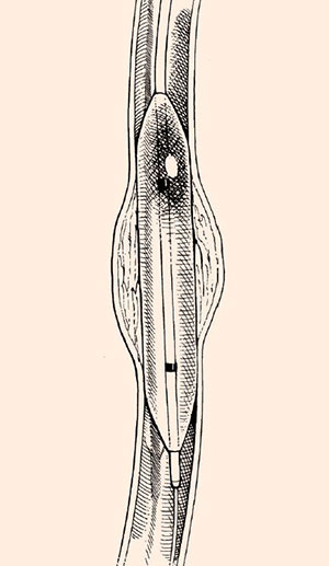 balloon catheter illustration NHCS