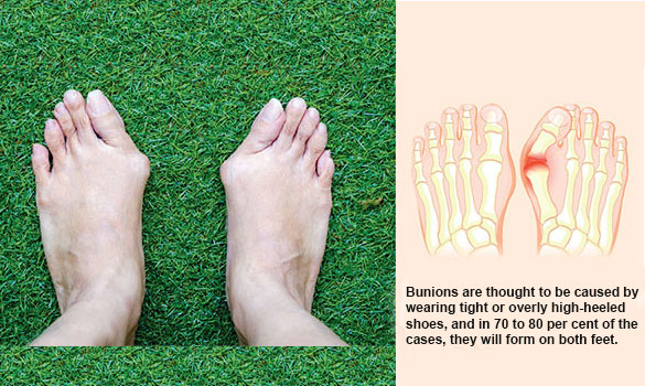 Causes of bunion - Singapore General Hospital