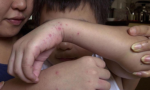 Tips to prevent Hand, foot and mouth disease - SingHealth Polyclinics