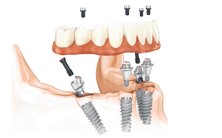 /sites/shcommonassets/Assets/News/false-teeth-dental-implant.jpg