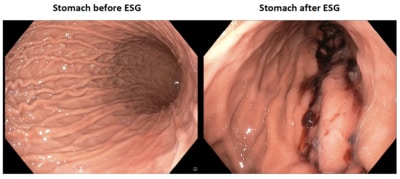 Endoscopic sleeve gastroplasty: before and after - SGH