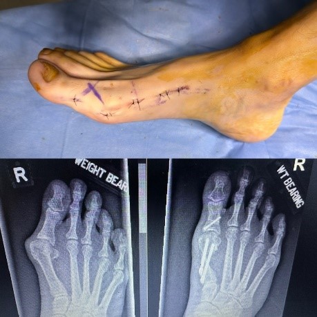 Minimally invasive bunion surgery - SKH