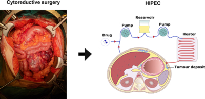 Schematic of CRS and HIPEC procedure - NCCS