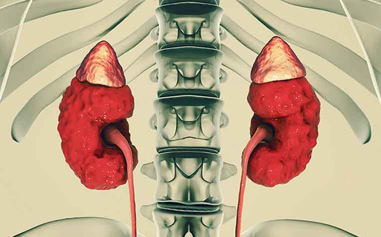 Second Most Common Cause of Kidney Disease that Many are Unaware of -  HealthXchange