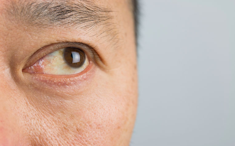 ​Cornea-Related Eye Conditions (Pterygium, Dry Eyes, Corneal Infection, Eye Infection) - Doctor Q&A​