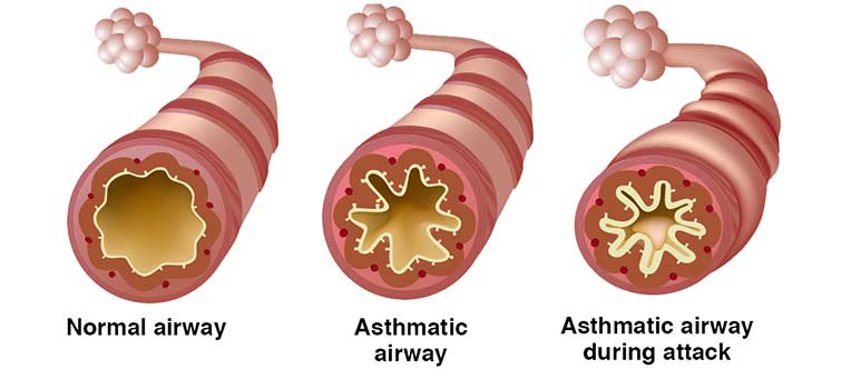 How asthma affects the airway.