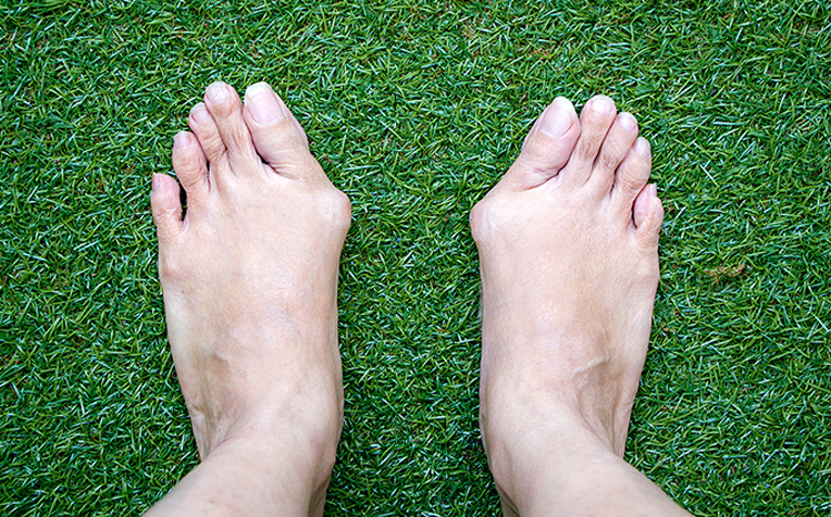 Bunion Treatment: Keyhole Surgery for Quicker Recovery