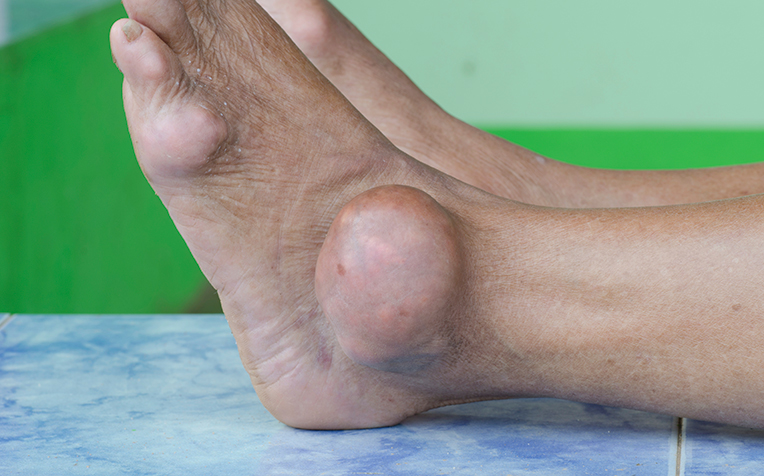 Gout: Causes, Symptoms, Treatment