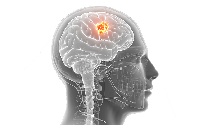 Brain Tumour: Causes and Symptoms