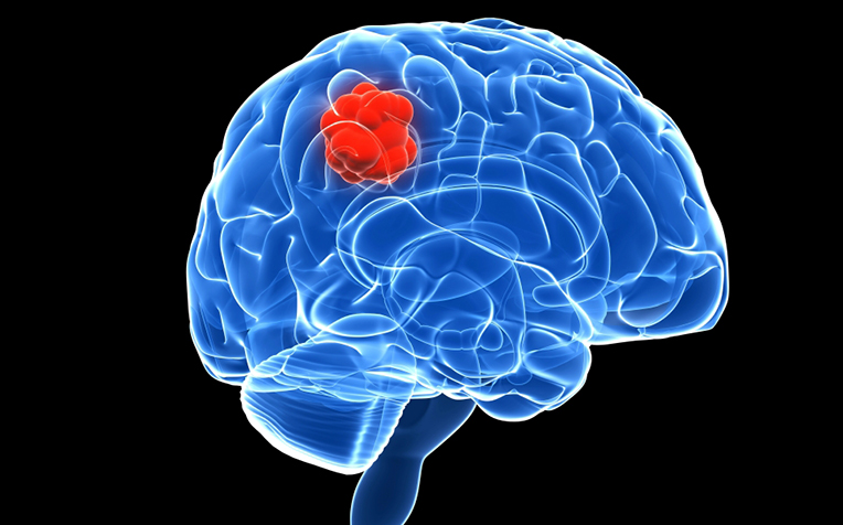 Brain Tumour: Risk Factors, Symptoms, Treatment