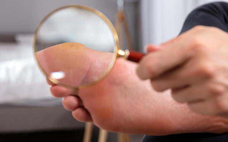 Diabetes Foot Care: How to Check Your Feet