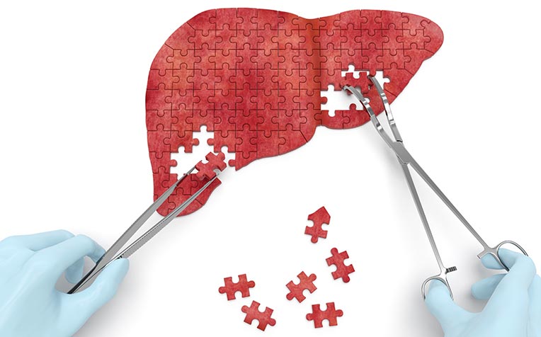Liver Cirrhosis: Treatment and Transplant