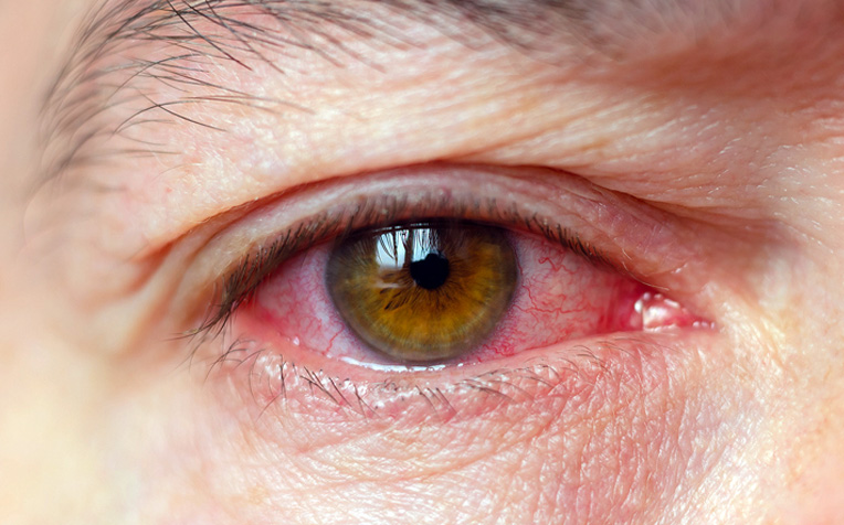 /sites/hexassets/Assets/eye-care/eye-ocular-inflammation-types-causes-treatment-b.jpg