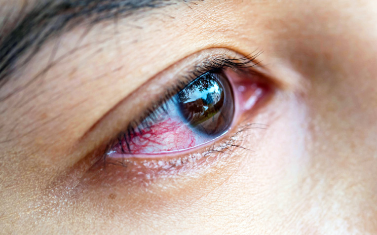 /sites/hexassets/Assets/eye-care/ocular-inflammation-and-immunology-page.jpg