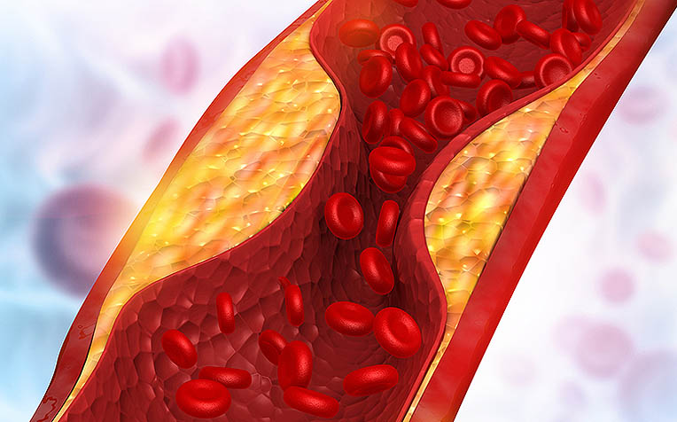 How Triglycerides Affect Your Heart