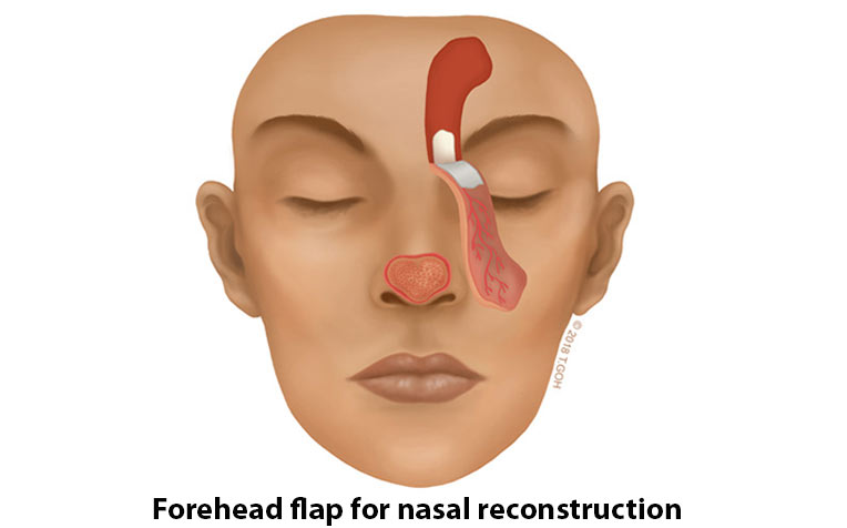 Forehead flap for nasal reconstruction