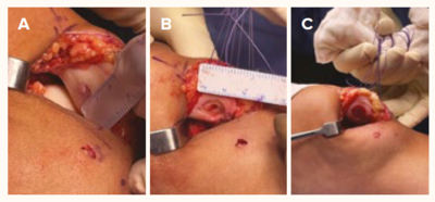 The surgical procedure of AMIC - SingHealth Duke-NUS Cell Therapy Centre