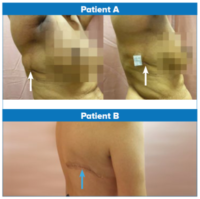 Comparison of endoscopic LD flap harvest vs conventional LD flap harvest - CGH