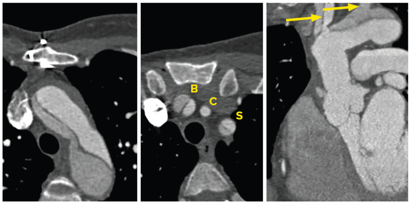 CT angiography with dissection of aortic arch - SingHealth Duke-NUS Vascular Centre