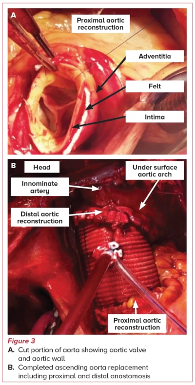 Acute aortic syndrome treatment - SingHealth Duke-NUS Vascular Centre