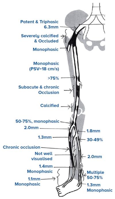 ultrasound arterial duplex - SingHealth Duke-NUS Vascular Centre