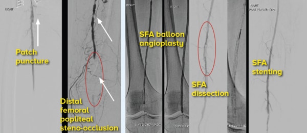 Angiographic images - SingHealth Duke-NUS Vascular Centre