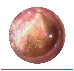 Otitis media - SingHealth Duke-NUS Head & Neck Centre