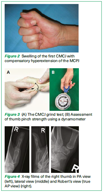Swelling of the first CMCJ;; diagnostic tests; X-ray films - SGH