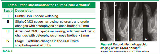Eaton-Littler classification - SGH
