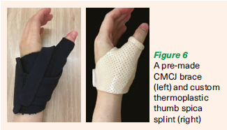 A pre-made CMCJ brace (left) and custom thermoplastic thumb spica splint (right) - SGH