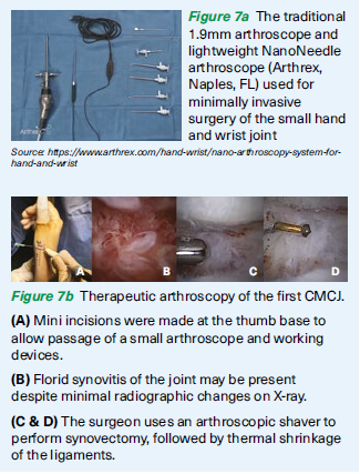 CMCJ arthroscopy - SGH