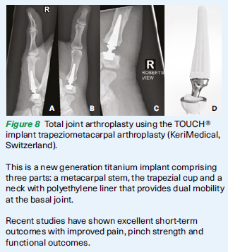 Total joint replacement (implant arthroplasty) - SGH